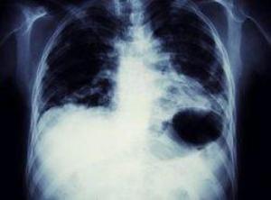 Lung Cancer Xray